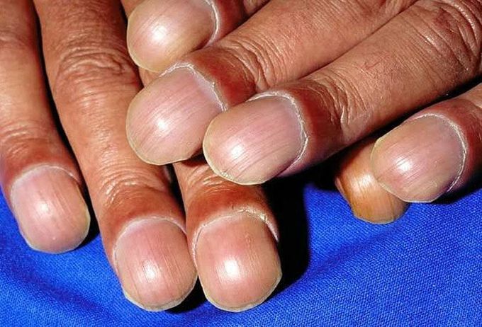 Nail clubbing