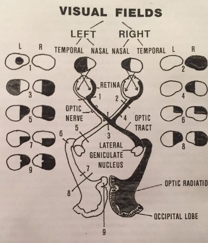 Optic pathway abnormalities