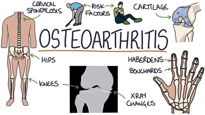 Osteoarthritis: A Diagrammatic Explanation