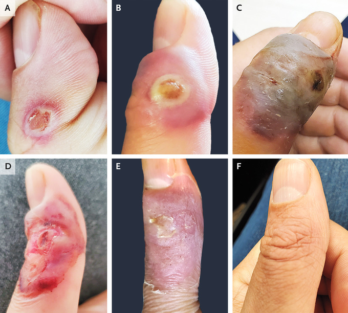 Orf - Case of Viral Skin Disease in 45-Year-Old Male