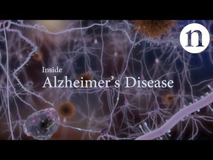 Alzheimer’s disease