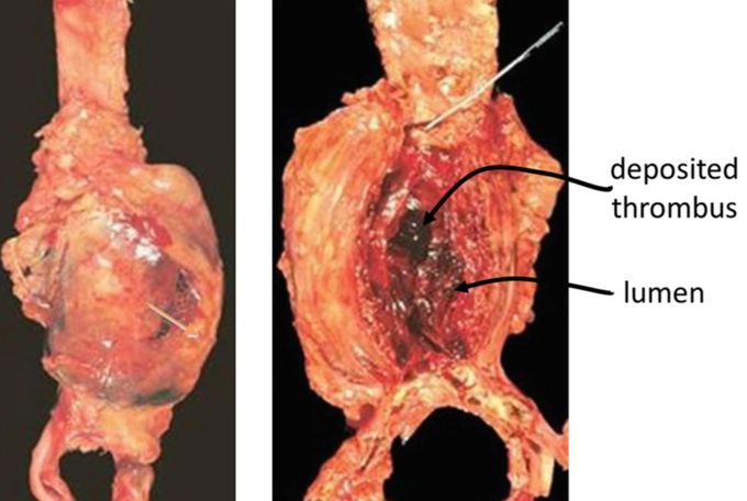 Aortic aneurysm