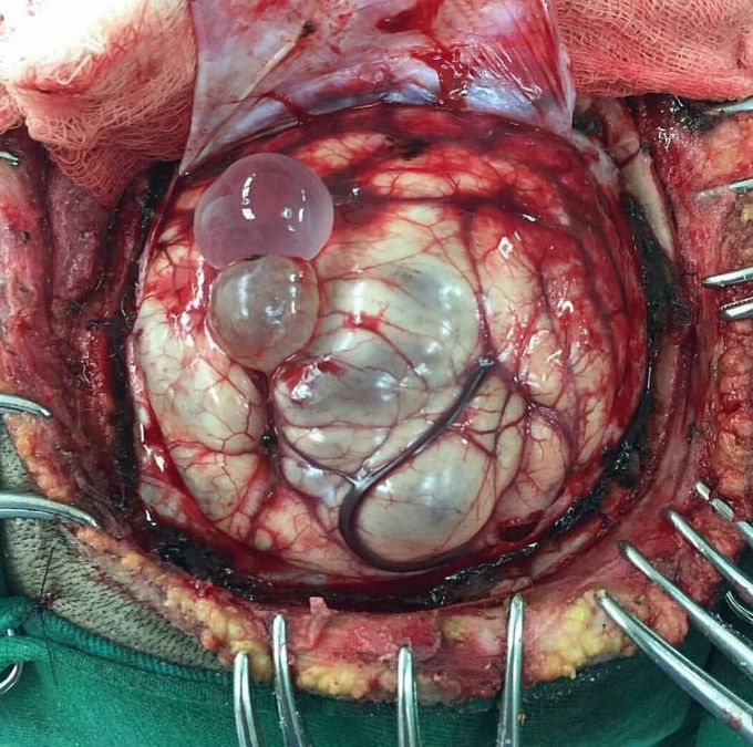 Neurocysticercosis