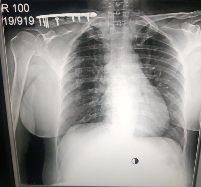 The case with clavicle fracture..... 😵