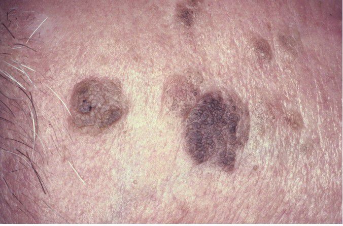 Seborrheic Keratosis - MEDizzy