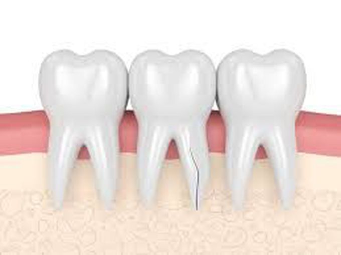 What is a cracked tooth?