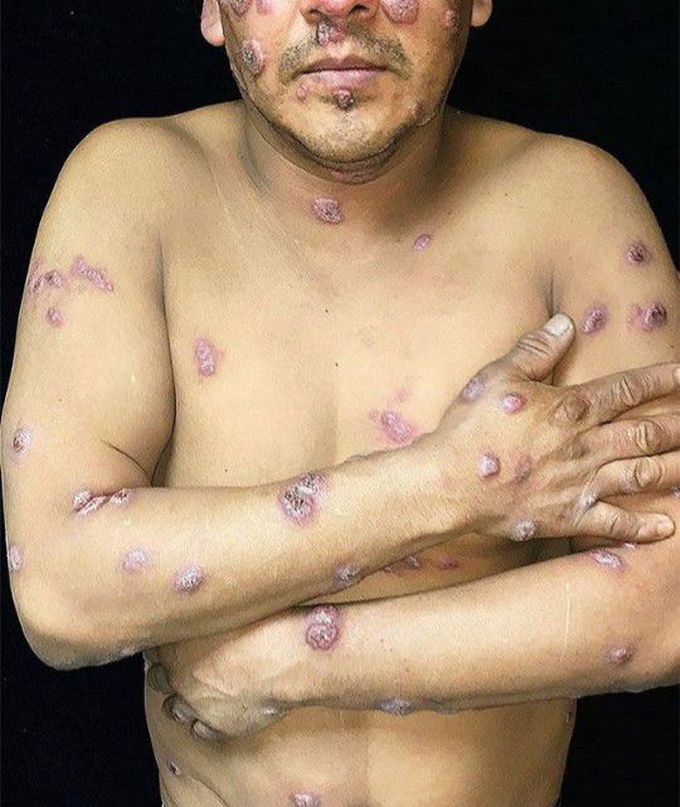 Disseminated cutaneous blastomycosis)))))
.........
A 44-year-old male construction worker presented to the dermatology clinic with nonpruritic skin lesions over his face, chest, back, arms, and legs. Six months earlier, he had fever, cough, and vomiting for 1 week. Skin biopsy showed pseudoepitheliomatous hyperplasia, intraepidermal neutrophilic abscesses, and round yeast forms with broad-based budding. 
It’s ((((Disseminated cutaneous blastomycosis)))))
.............................
.Do Share With Friends↗️
Turn on post notifications to never miss a post↗️ 🔸️🔸️🔸️🔸️🔸️🔸️🔸️🔸️🔸️🔸️🔸️🔸️🔸️🔸️🔸️
Comments below👇