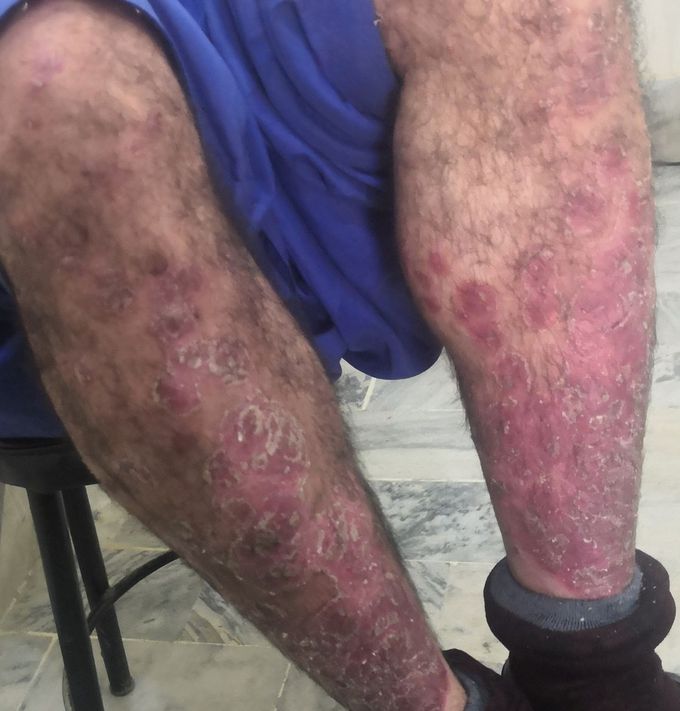 Dermatitis.