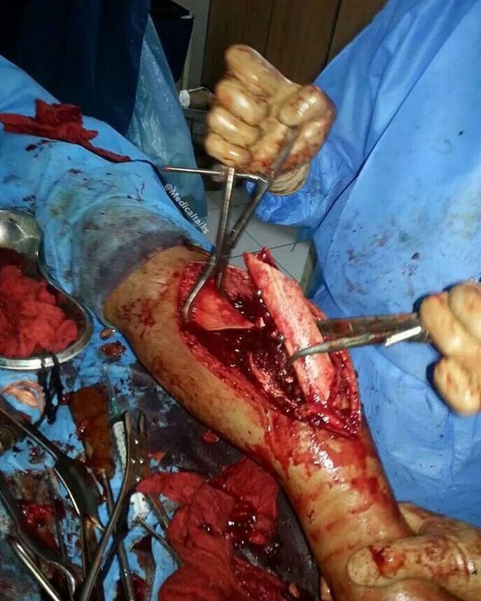 Severe open tibial fracture prior to fixation!! 