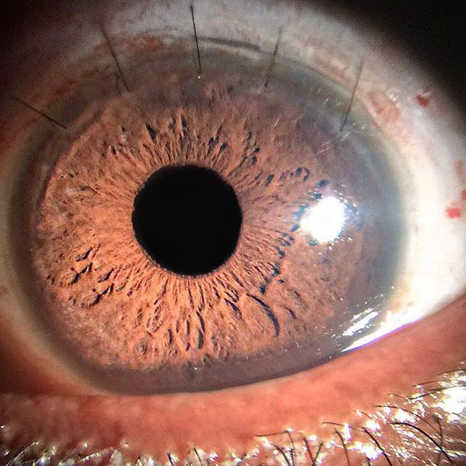 Corneal sutures