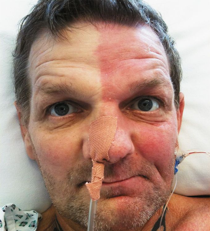 Hemifacial Flushing