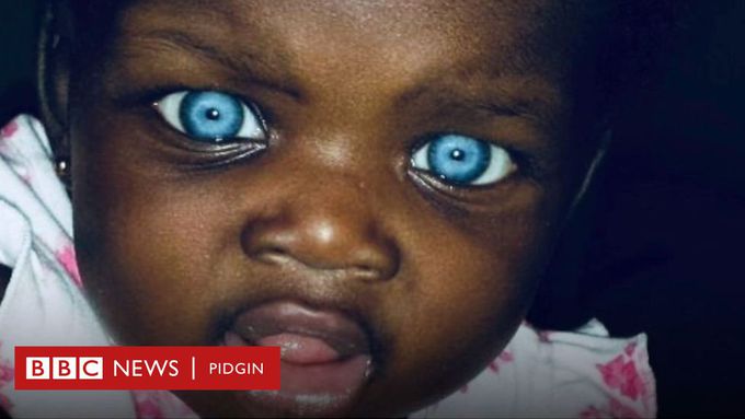 Blue-eyed(waardenburg)