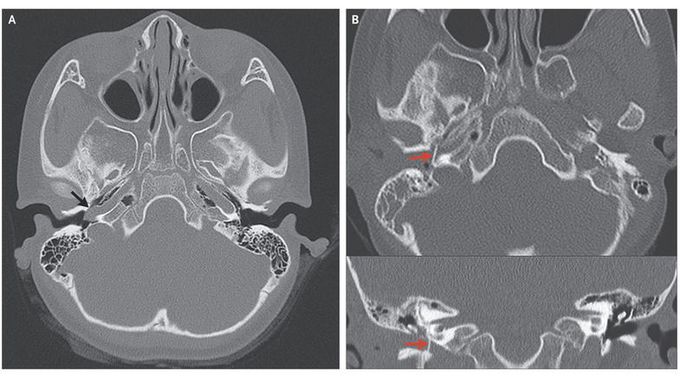 Internal Carotid Artery in the Middle Ear