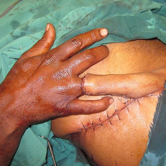 Finger avulsion injury!