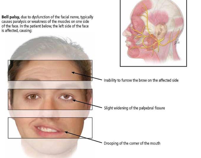 Bell's palsy.