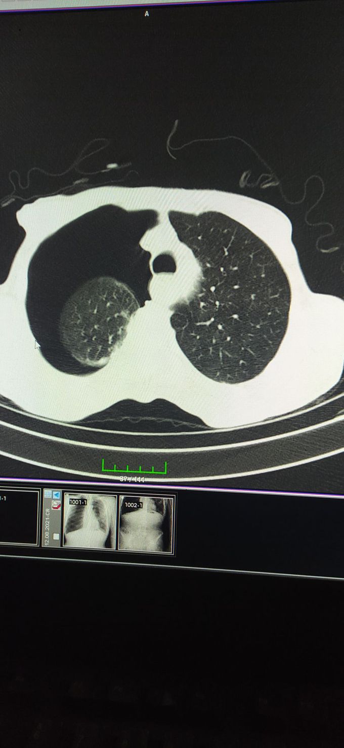 İatrogenic Pneumothorax