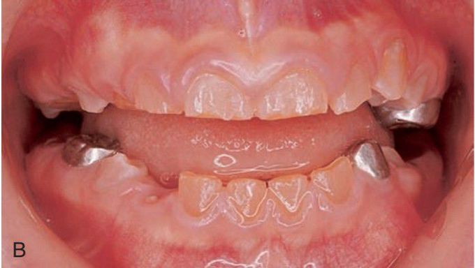 Dentinogenesis imperfecta