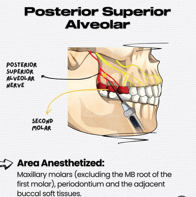 Maxillary Local Anesthesia V