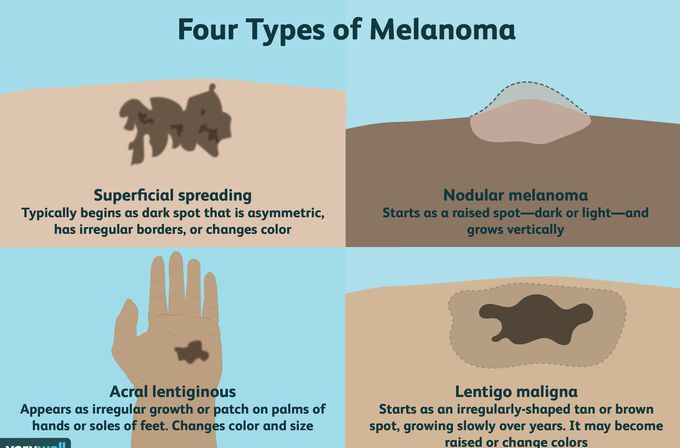 Types of Melanoma