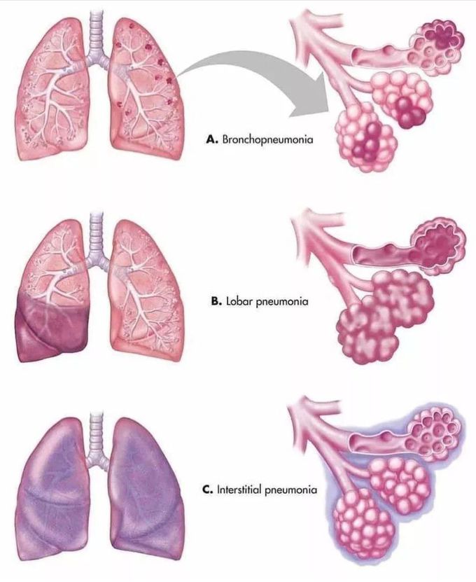 Types of Pneumonia