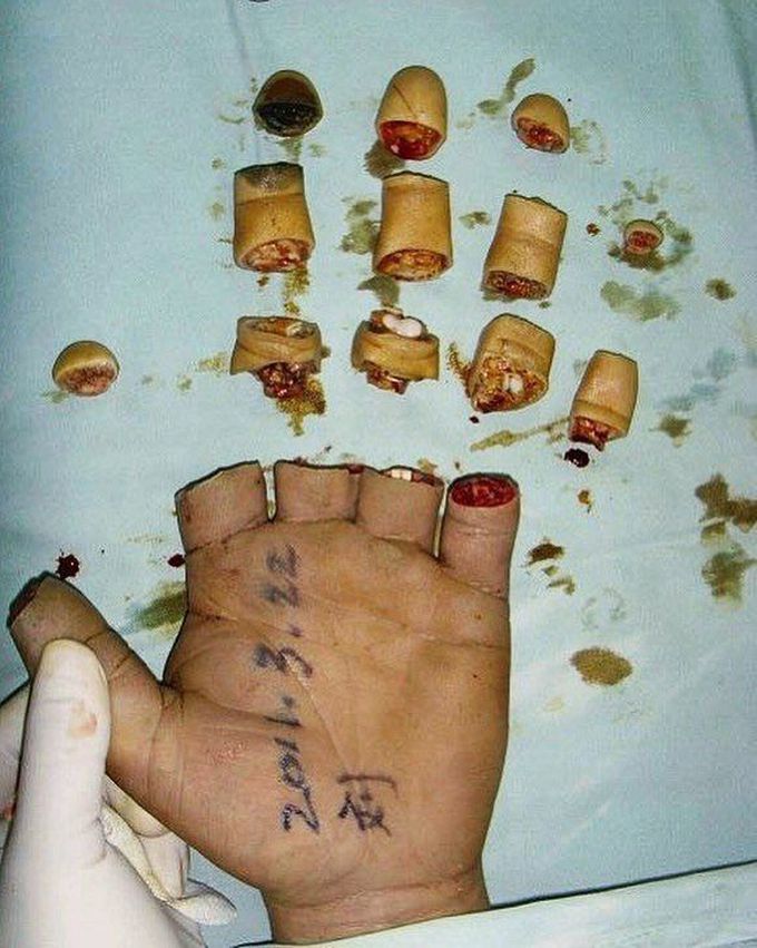 Unbelievable case of severe hand trauma! 