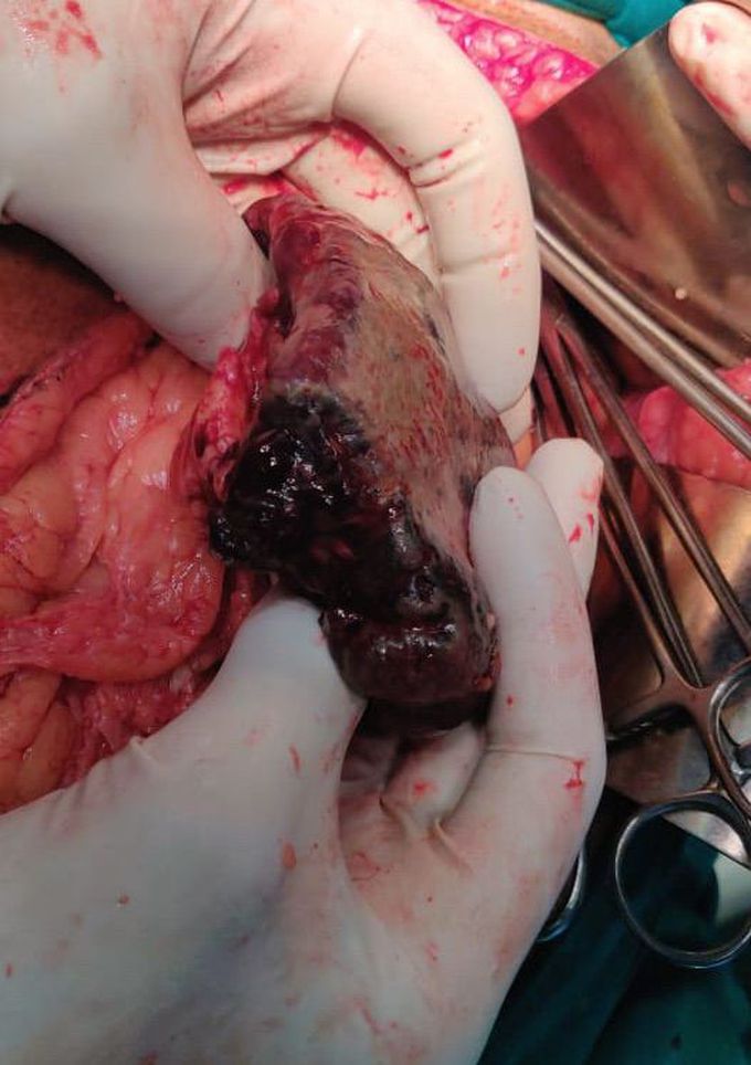 Spleenic infarct secondary to pancreatitis