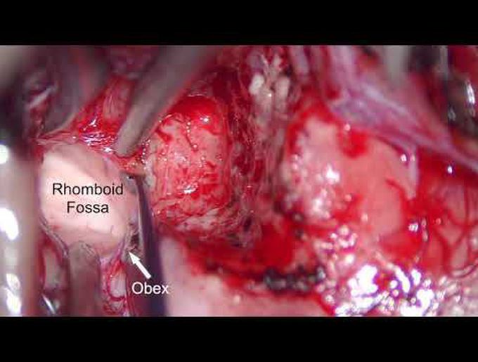 Microsurg resect of brainstem cervicomedullary ganglioglioma: surg pseudoplane for near-total resect