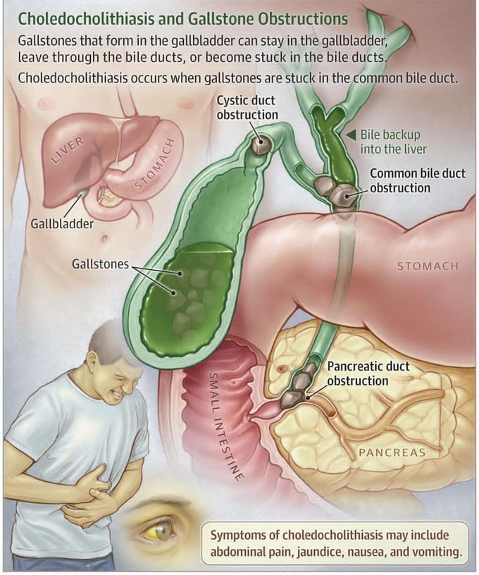 Choledocholithiasis.