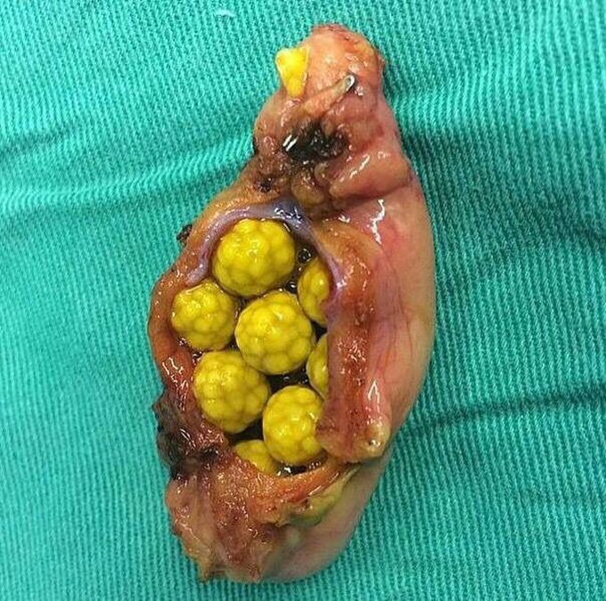 Cholesterol gallstones