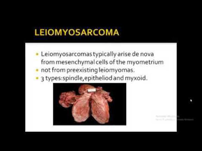 Leiomyoma vs Leiomyosarcoma of uterus