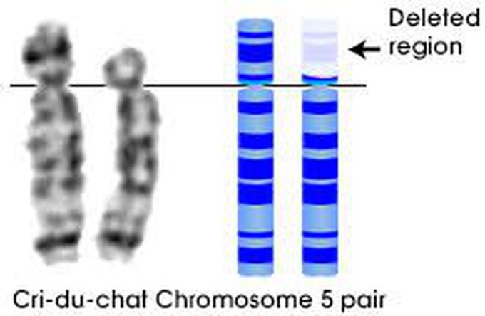 Cri du chat syndrome- crying like a cat!