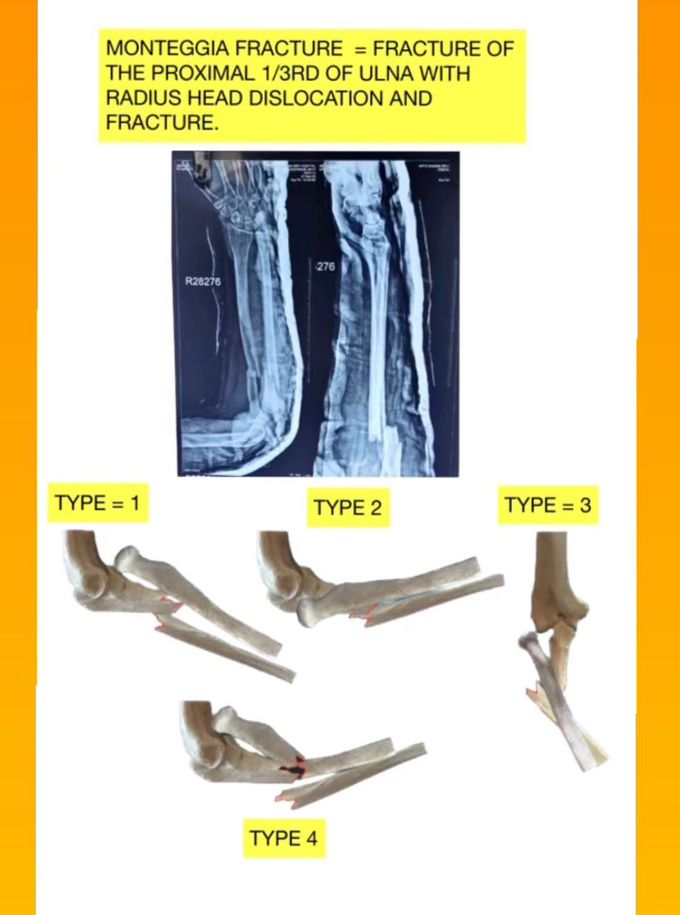 Monteggia Fracture