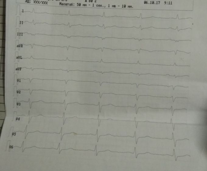 ECG analyse??
