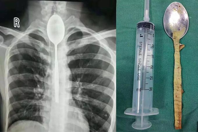 Man had a spoon stuck in his esophagus for a year!!