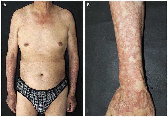Generalized Granuloma Annulare Associated with Diabetes Mellitus