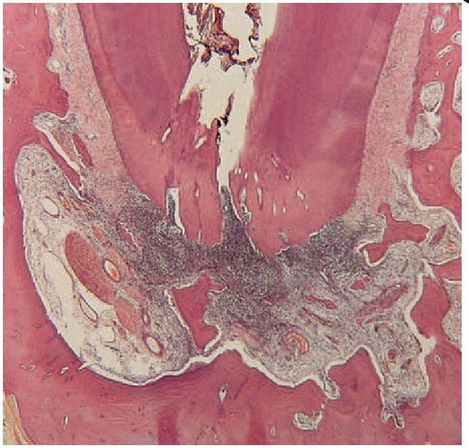 Acute apical periodontitis.