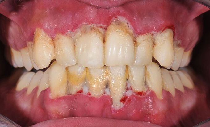 Symptoms of White gums