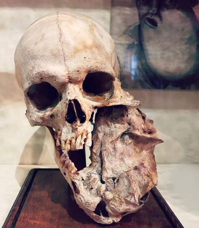 Here is a skull of a patient died suffering from a mandible tumor
