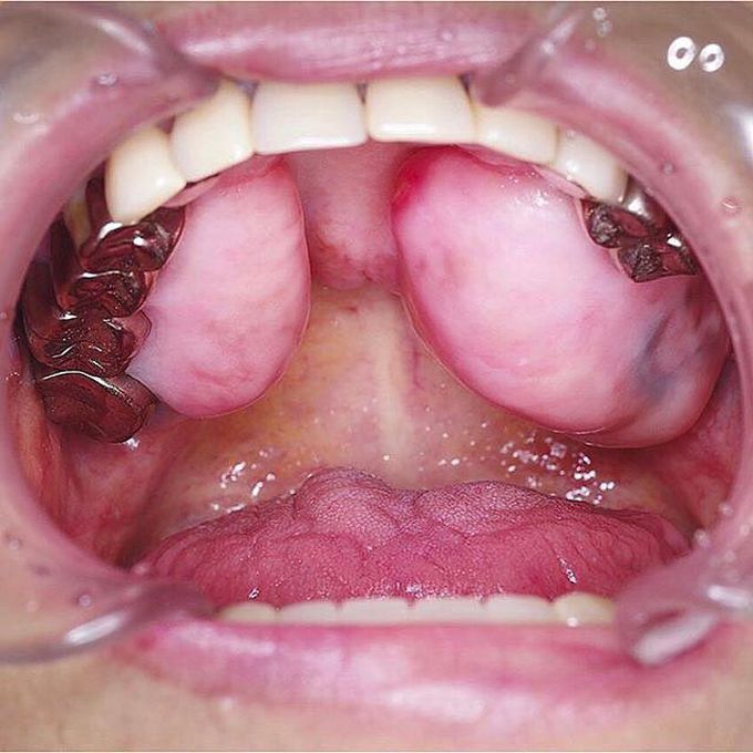 Oral exostosis