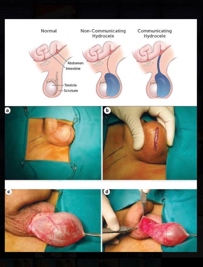 Hydrocele