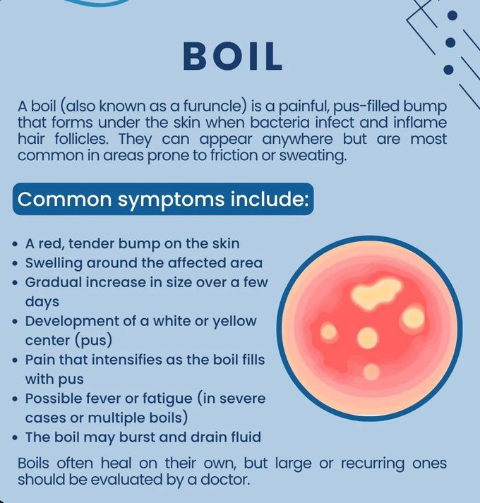 A Boil