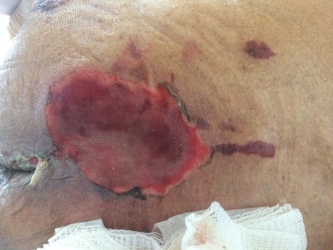 Sacral lesion