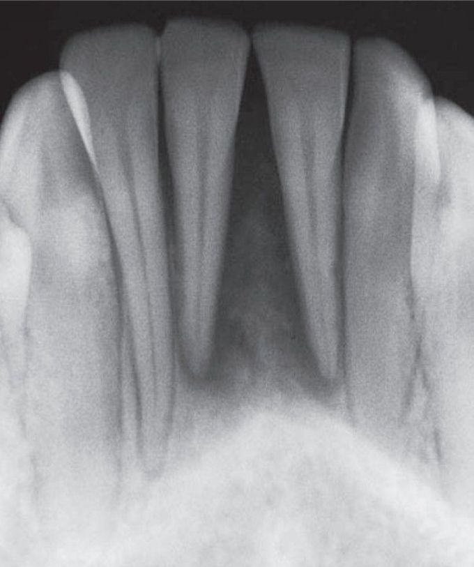 Metastatic osteosarcoma to anterior mandible