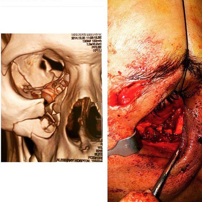 Orbital blowout fracture due to trauma