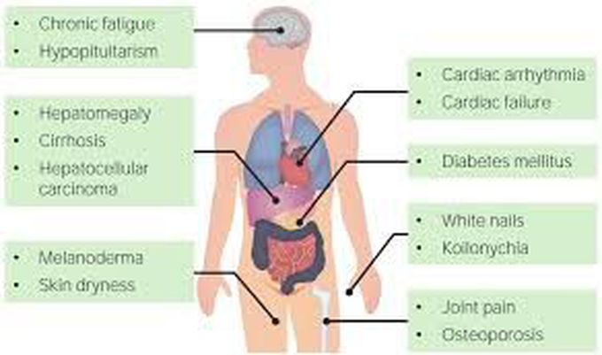 Symptoms Of Hemochromatosis MEDizzy