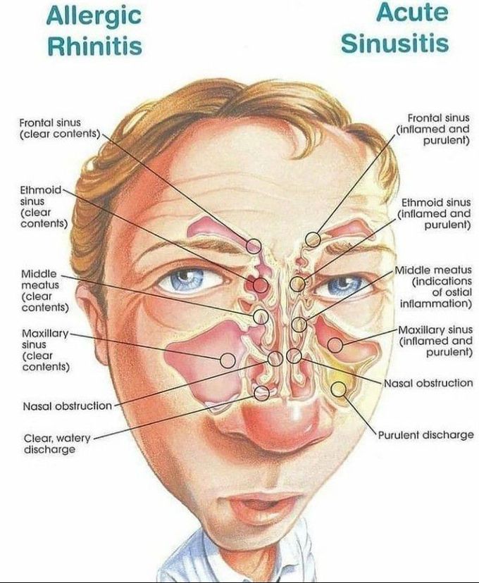 Allergic rhinitis and acute sinusitis