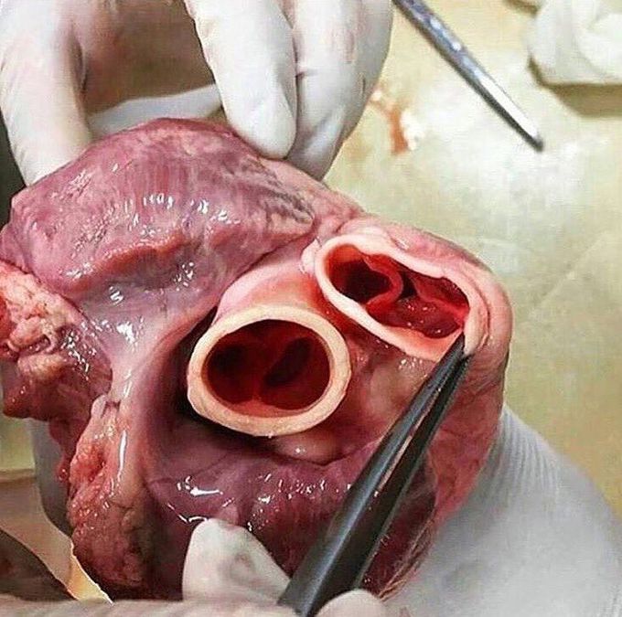Heart valves