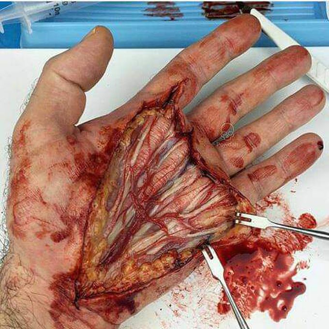 Hqnd surgery