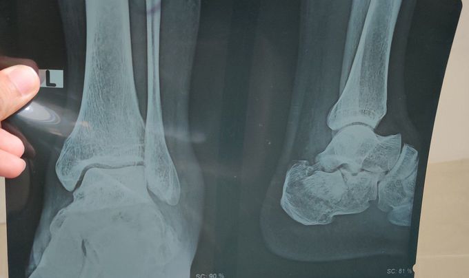 Calcaneum Fracture