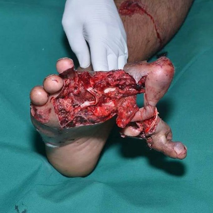 Crush injury of the foot!